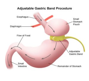 adjustable-gastric-band